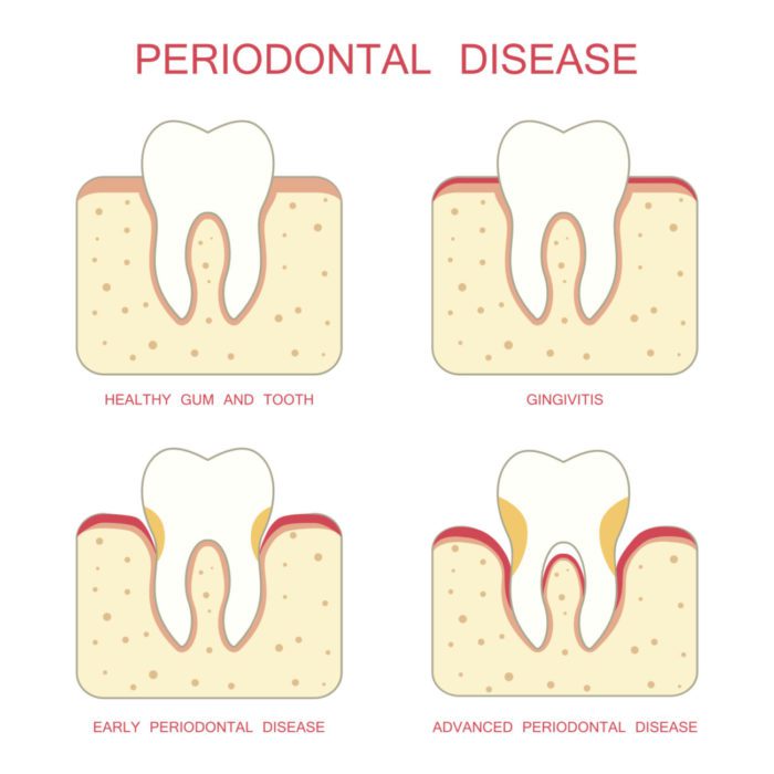 periodontal therapy amherst ny