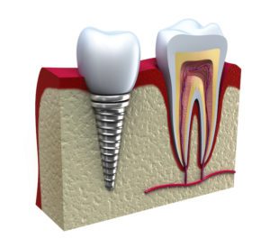 dental implants amherst ny