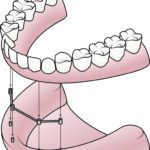 dental implant dentures amherst ny