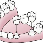 implant secured dental bridge amherst ny