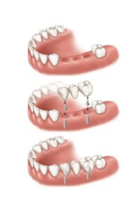 multiple teeth implants amherst ny