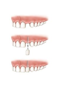 single tooth implant amherst ny