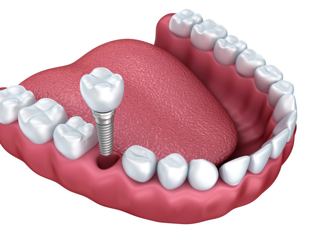 dental implant amherst ny