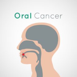 Oral Cancer amherst ny