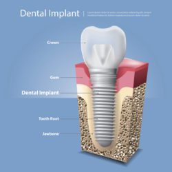 benefits of dental implants amherst ny