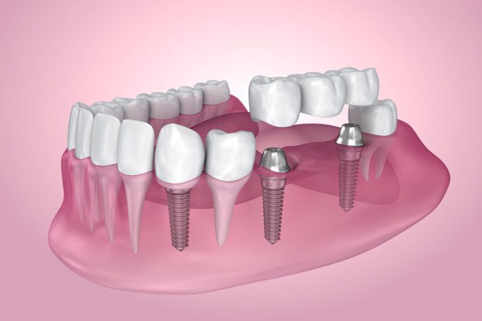 dental implants amherst ny