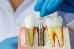 Amherst, ny dental implants