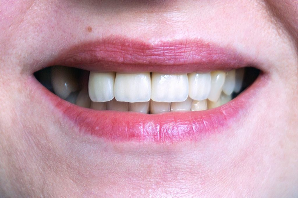closeup image of person smiling with one missing canine tooth loss missing teeth restorative dentistry dentist in Amherst New York