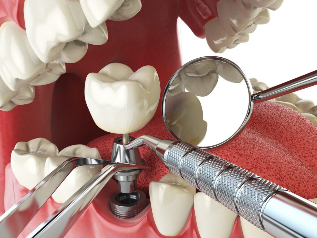 DENTAL IMPLANTS in AMHERST NY could provide bite restoration in just one day